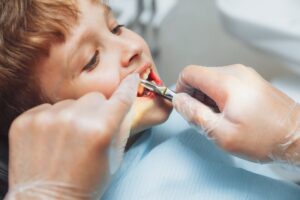 Tooth Extraction
